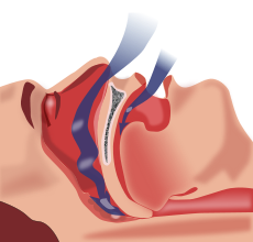 apnee obstructiva