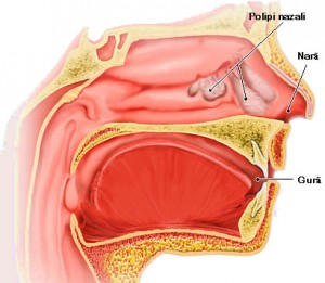 Sforaitul - polipi nazali